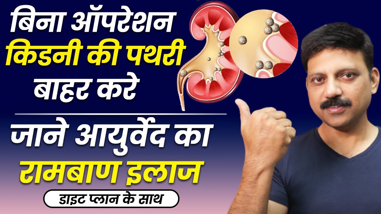 बिना ऑपरेशन किडनी की पथरी का रामबाण इलाज | Kidney Stone Treatment at Home | Manas Samarth | Hindi